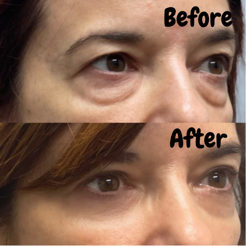 Eye Tightener - Lakerain™