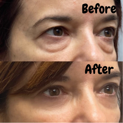 Eye Tightener - Lakerain™