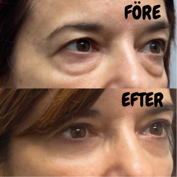 Eye Tightener - Lakerain™