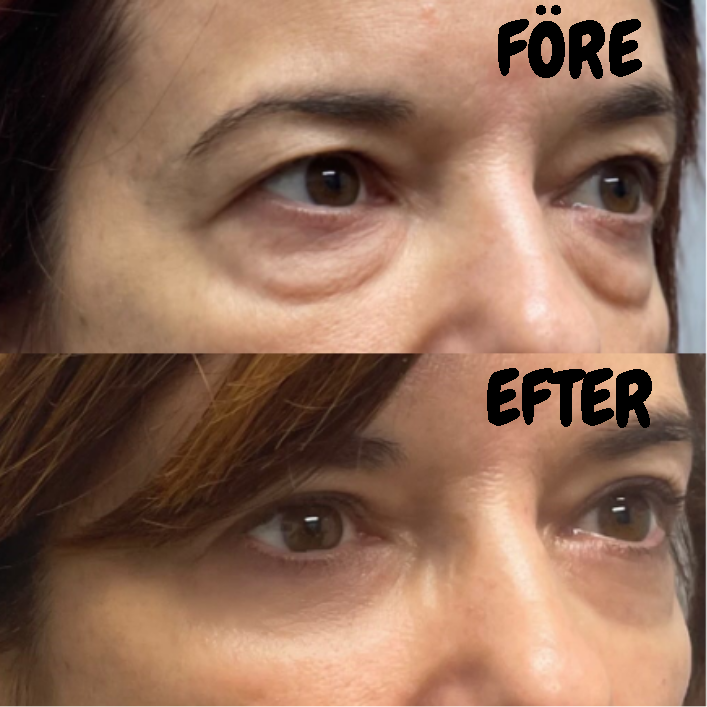 Eye Tightener - Lakerain™